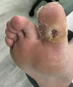 a picture showing diabetic foot ulcer 