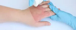 burn treatment of a hand in process