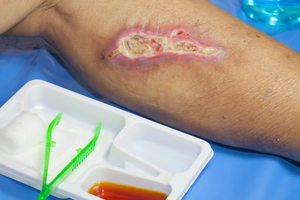 Wound Infections