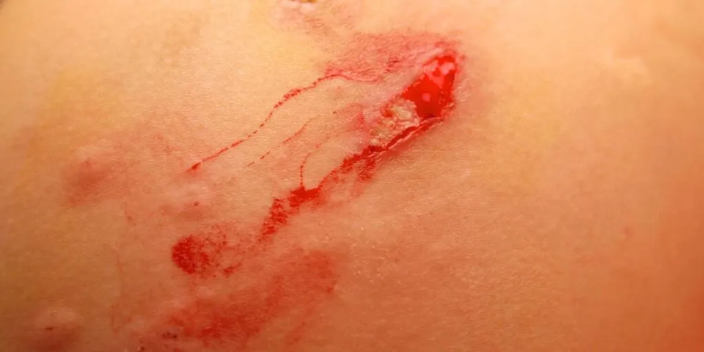 Fungal Wound Infections