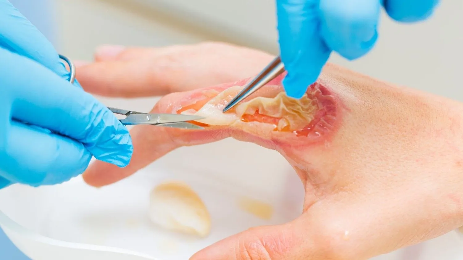 Enzymatic Debridement