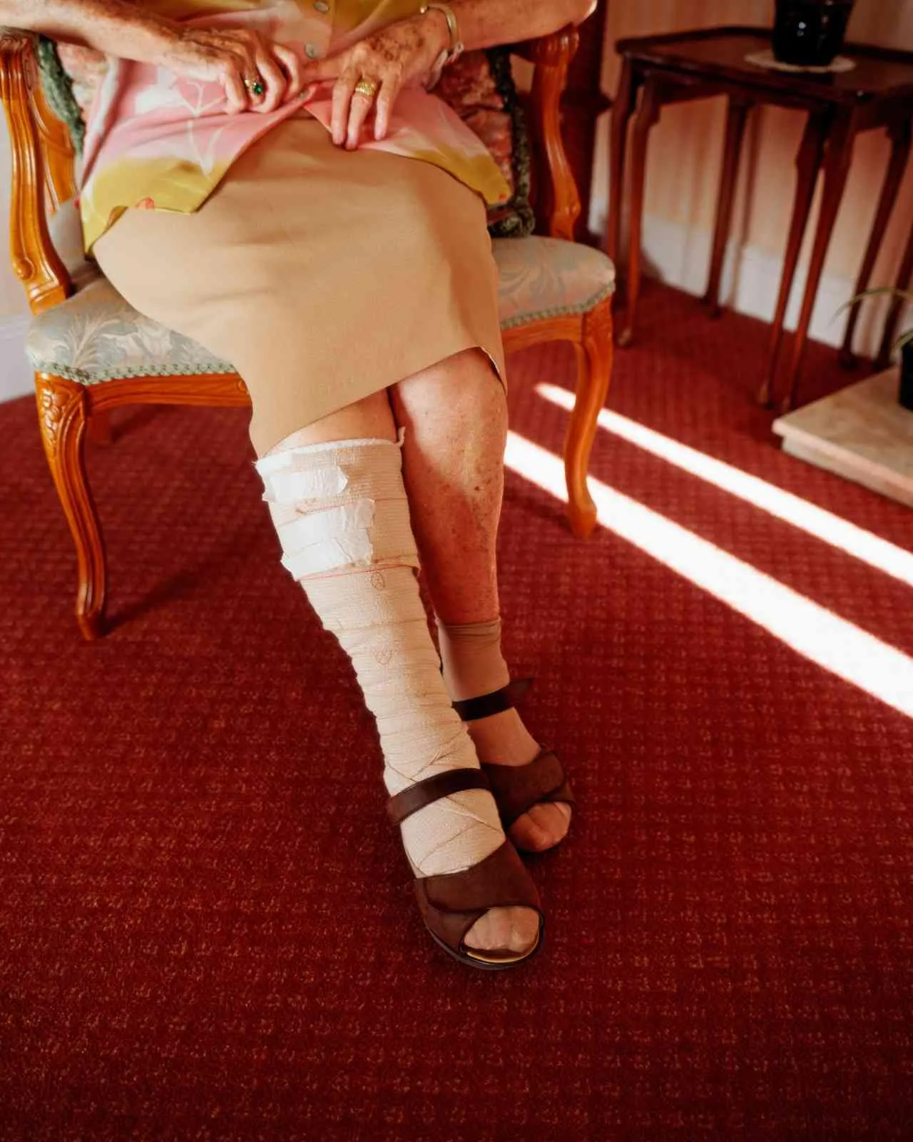 Wound Care, Alzheimer’s Patients, dementia, caregiver guidance