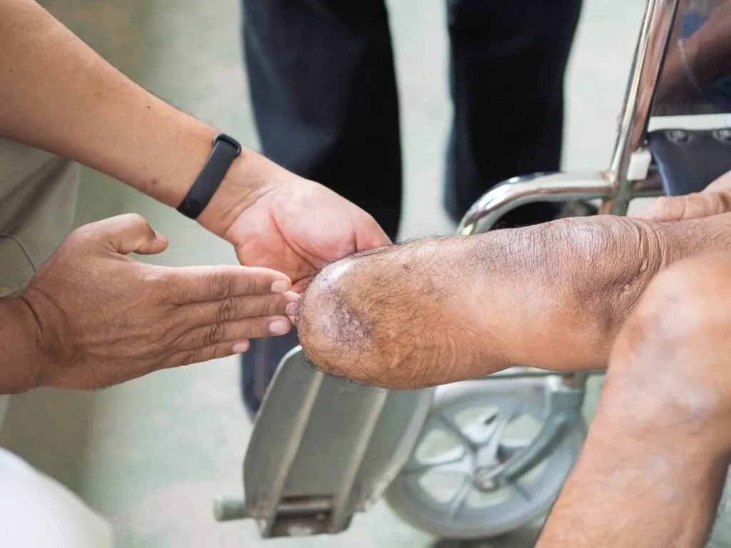 limb salvage, amputation criteria, vascular wounds