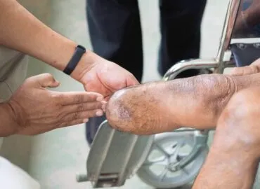 limb salvage, amputation criteria, vascular wounds